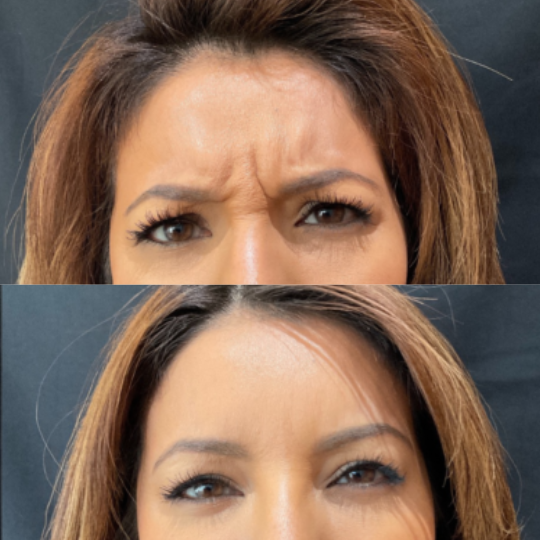 before and after results of botox in lone tree at DejaVu Med Spa